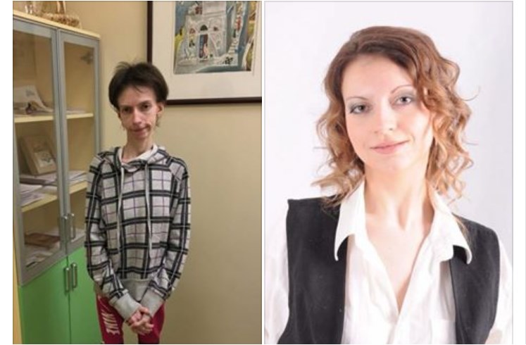 “Жінка довела себе до ваги 23 кг, а все через…”: Користувачів Мережі вразила історія українки